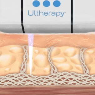 How Ultherapy Works | Mizu