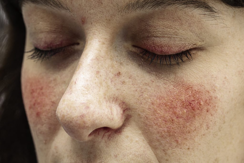 Rosacea - Close Up View | Mizu