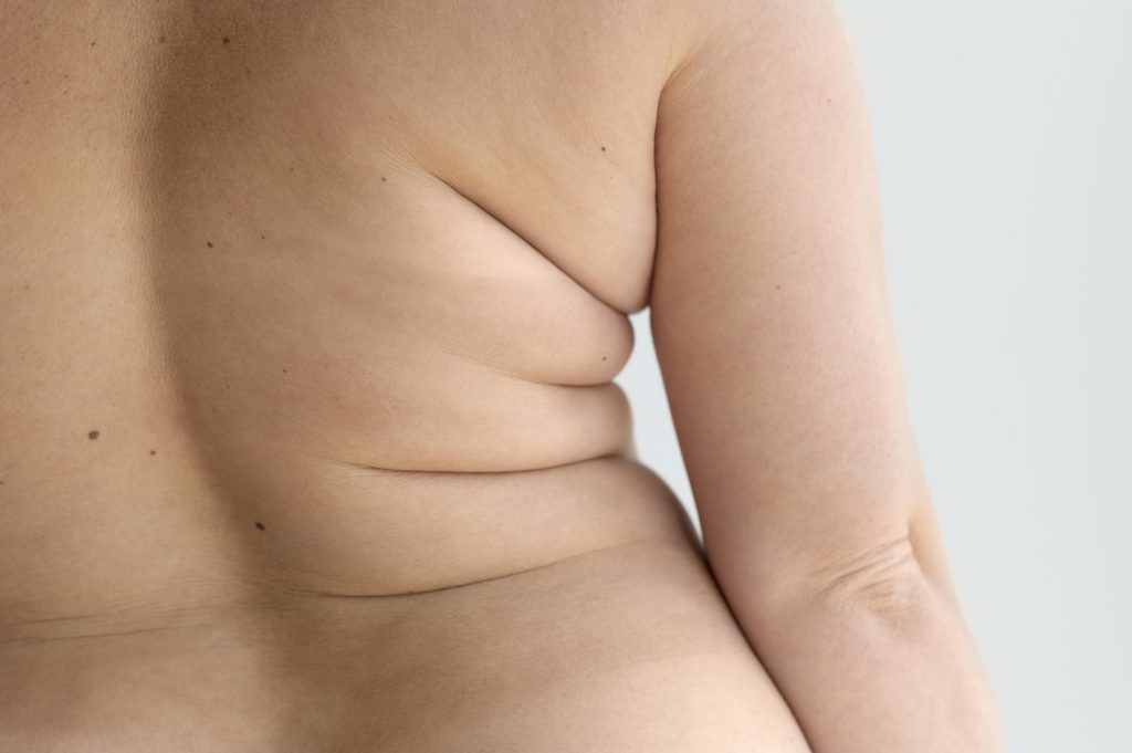 Body Fat Reduction - Bra Fat and Flabby Arms | Miziu