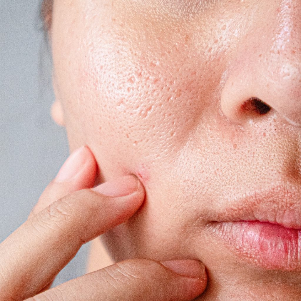 Dull Skin - Enlarged Pores | Mizu