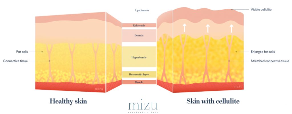 Onda Coolwaves Body Sculpting - Healthy Skin vs Skin w/ Cellulite | Mizu