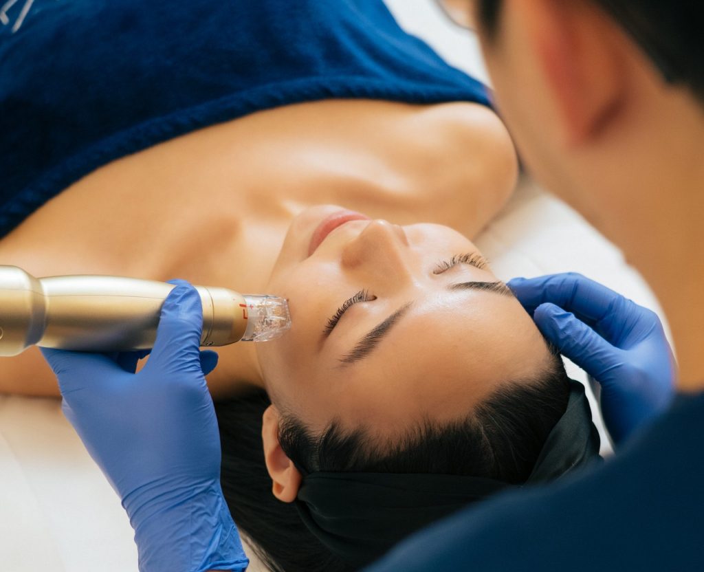 Acne Scars - Using Mizu RF Microneedling | Mizu