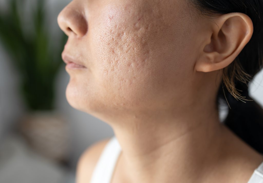 Acne Scars - Teenage Girl w/ Acne Problem | Mizu