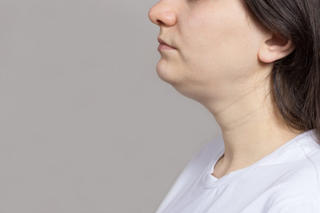 Double Chin and Jowls | Mizu