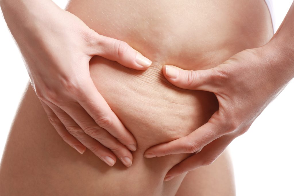 Cellulite Problem | Mizu