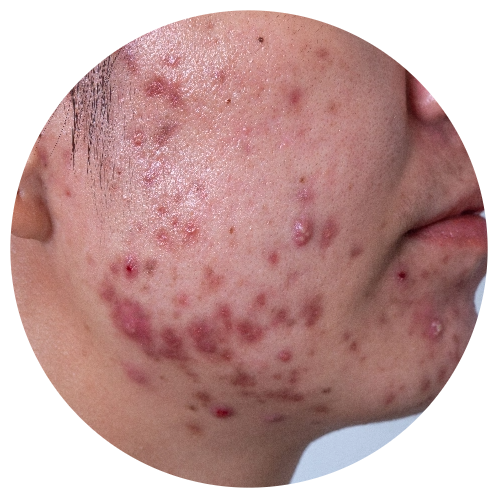 Acne - Acne Conglobata | Mizu