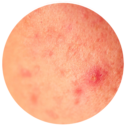 Rosacea - Bumps & Pimples | Mizu