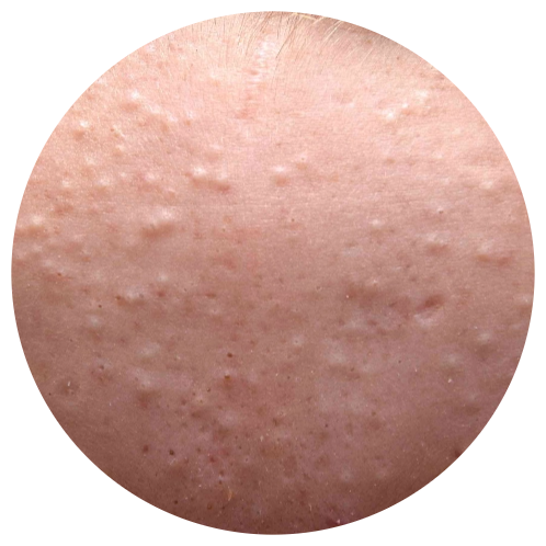 Acne - Comodones | Mizu