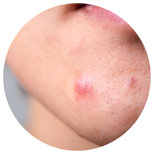 Acne - Cystic Lesions | Mizu