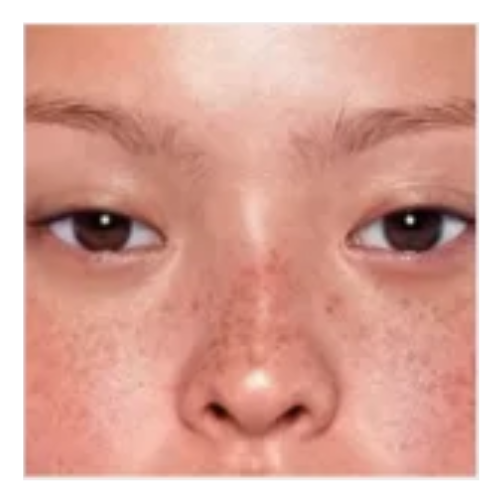 Skin Pigmentation - Freckles | Mizu