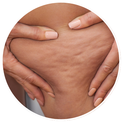 Cellulite - Grade 1 | Mizu