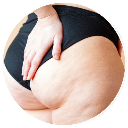 Cellulite - Grade 2 | Mizu
