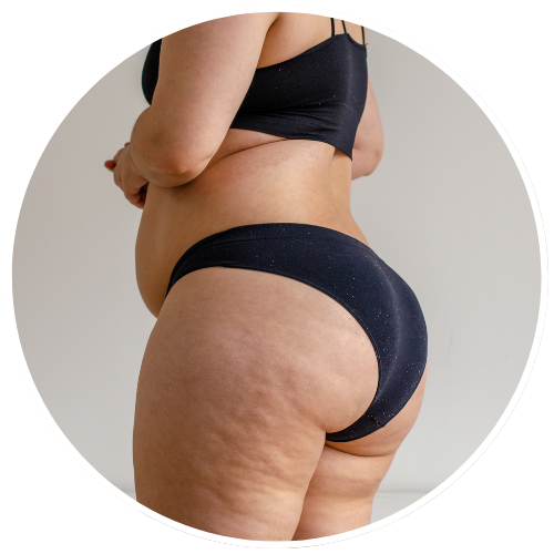 Cellulite - Grade 3 | Mizu