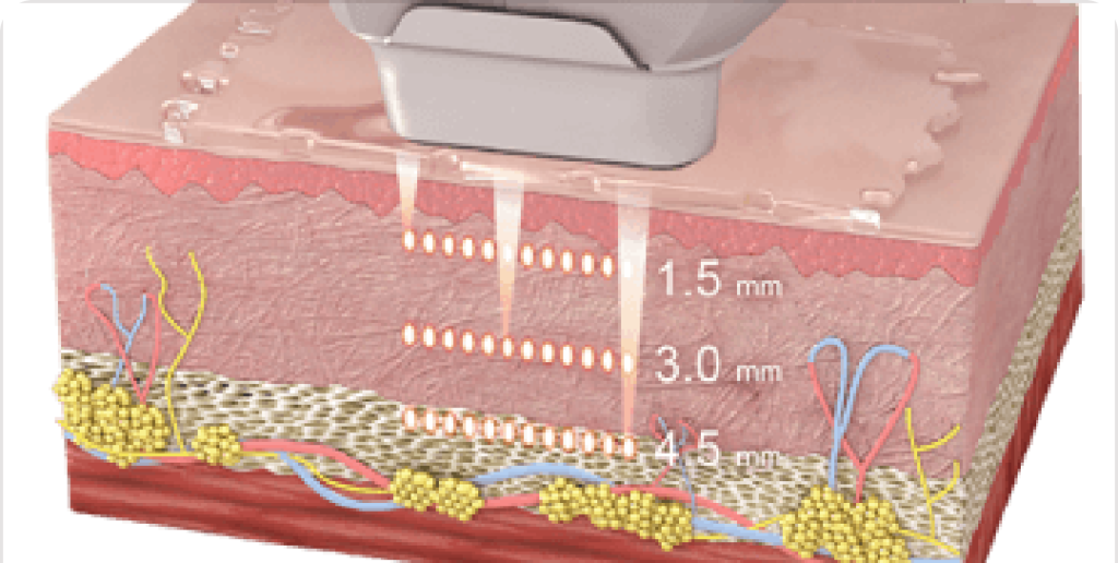 HIFU Ultherapy | Mizu