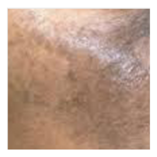 Skin Pigmentation - Nebus of Ota | Mizu
