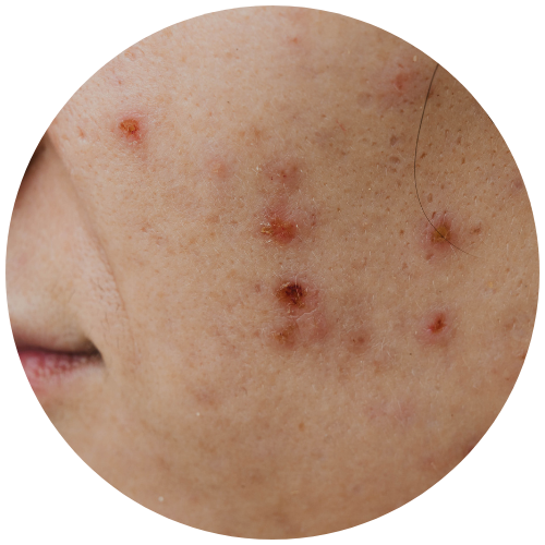 Acne Scars - PIE | Mizu