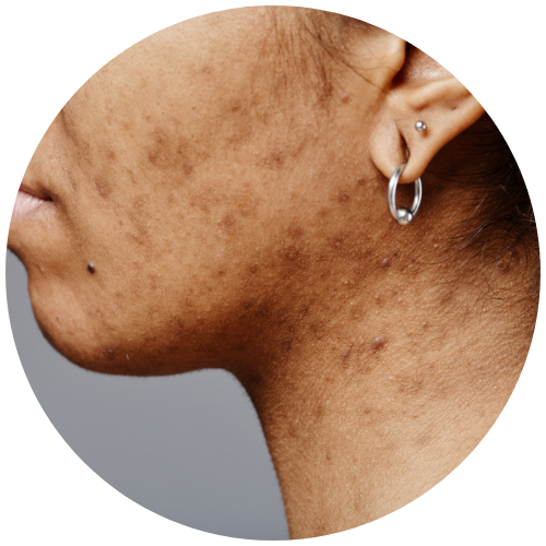 Acne Scars - PHI | Mizu