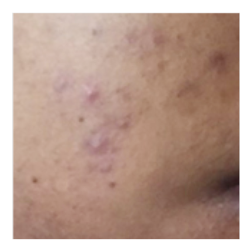 Post-inflamatory Hyperpigmentation | Mizu
