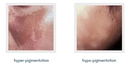 Hyper-pigmentation vs Hypo-pigmentation | Mizu