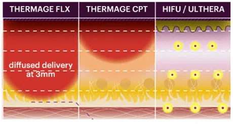 All Treatments: Thermage FLX, Thermage CPT & HIFU / ULTHERA | Mizu