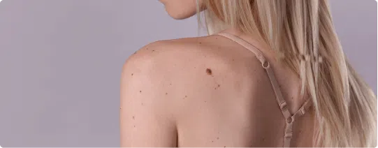 Mole, Milia & Skin Tag Removal | Mizu