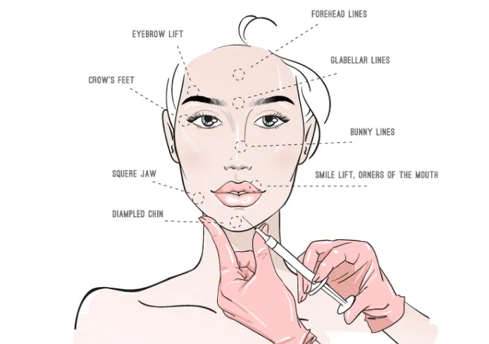 Areas that can use Fillers | Mizu