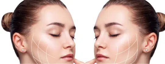 Chin Fillers | Mizu