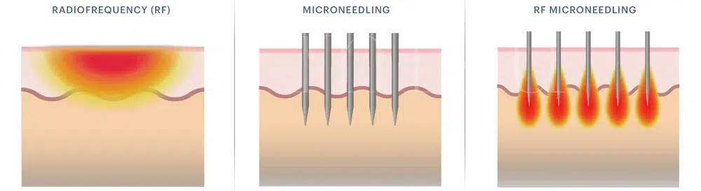 Acne Scarring Treatment: Radiofrequency (RF), Microneedling & RF Miconeedling | Mizu